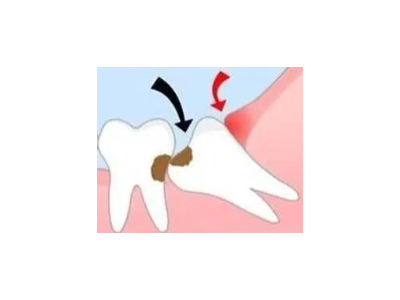 吃完飯后老塞牙？別大意！這可能是你的牙齒在報(bào)警
