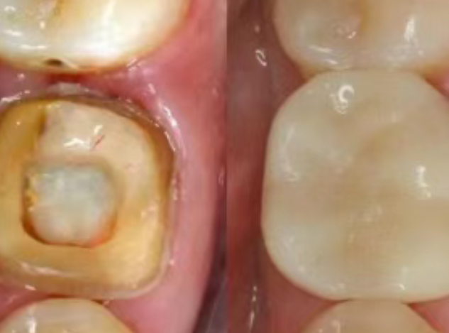 根管治療（抽神經(jīng)）后，為什么一定要做牙冠？