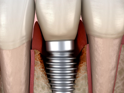 種植牙的術(shù)前準(zhǔn)備有哪些？