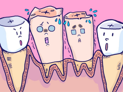 人工種植牙系列——即刻種植術(shù)講解