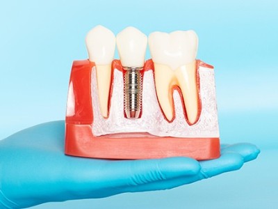 種牙VS鑲牙，你適合哪種?
