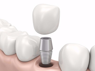 在承德哪家口腔醫(yī)院口腔種植齒好一點(diǎn)，惟德口腔醫(yī)院值得您的選擇