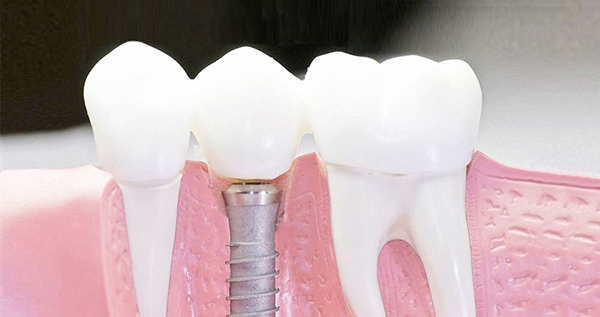 在承德口腔種植牙齒需要多少錢？惟德口腔一一為您道來