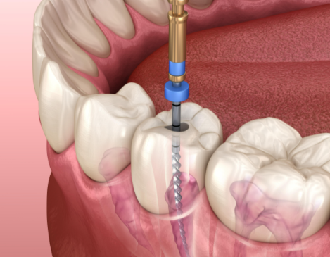 根管治療后的注意事項(xiàng)有哪些？