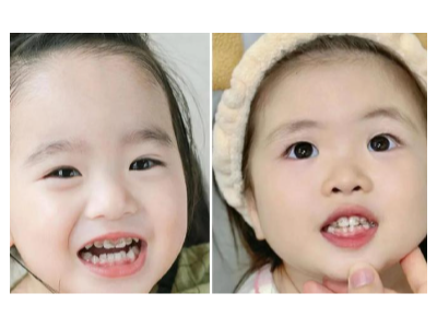 河北惟德口腔涂氟太貼心，孩子不抗拒，家長更省心