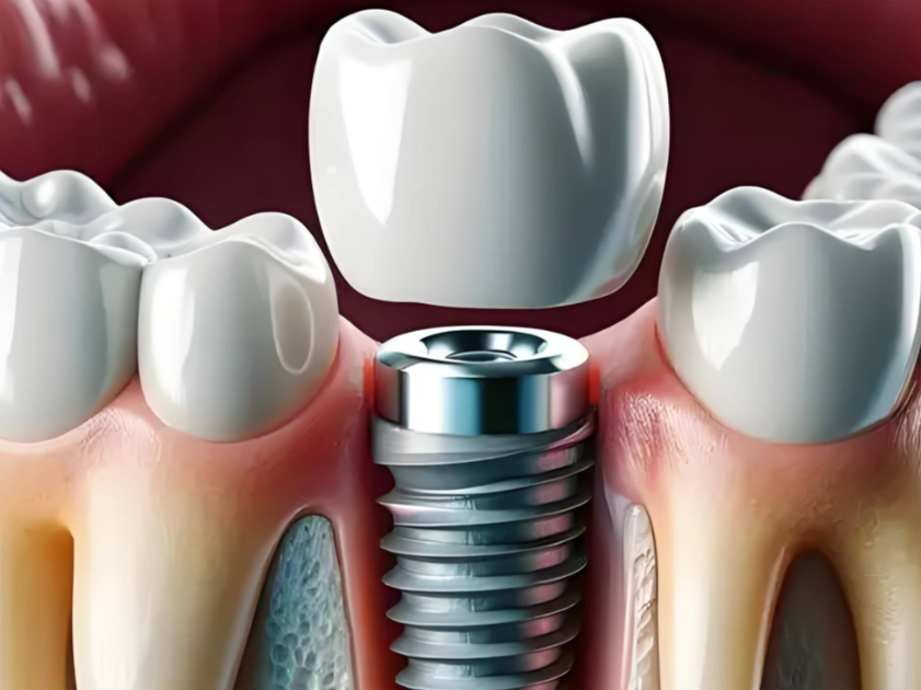 對(duì)于老年人來說，裝假牙和種植牙哪個(gè)更好